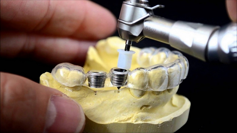 when can i exercise after dental implant_2