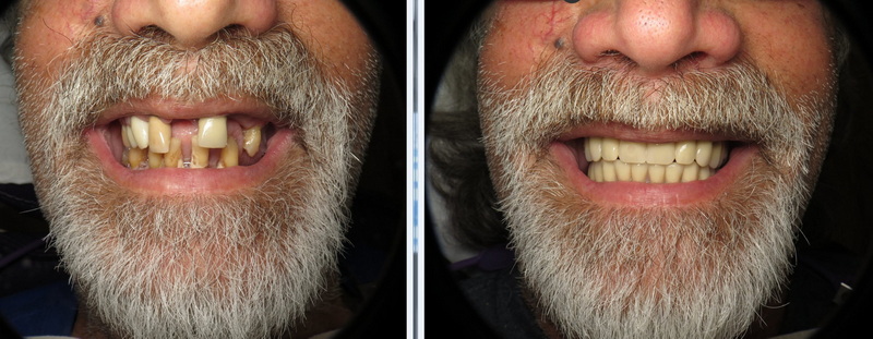 What To Do If A Dental Implant Falls Out?