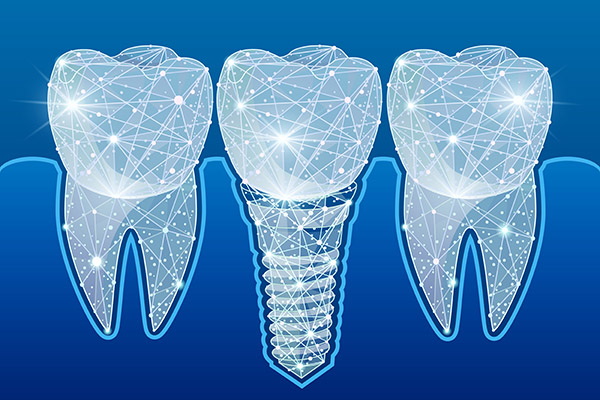 What To Do After A Dental Implant?
