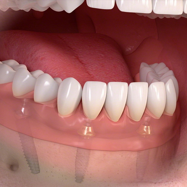Who Is The Best Dental Implant Dentist Near Me?