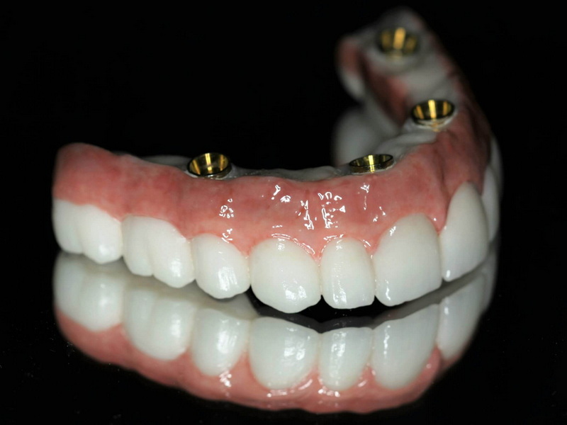 dental implant brand 