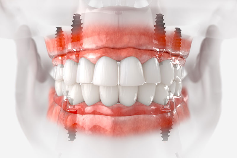 what is next step after dental implant_3