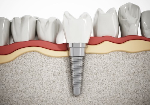 Who Pays for Failed Dental Implant?