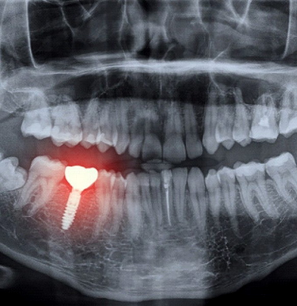 my dental implant fail_2