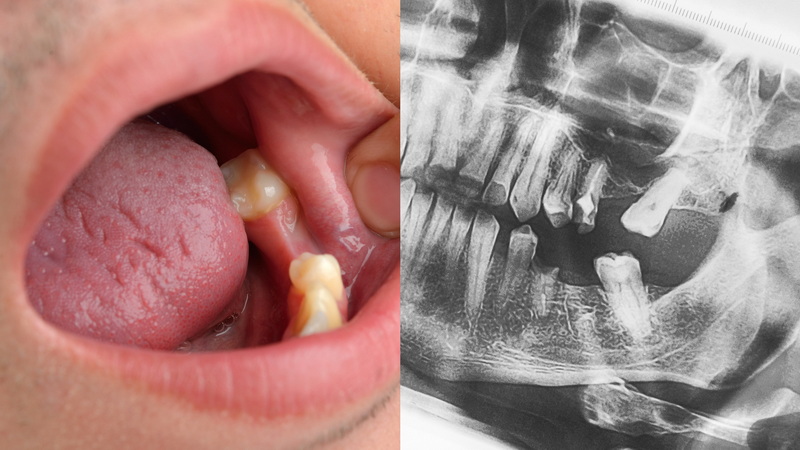 Why Does My Dental Implant Feel Weird?
