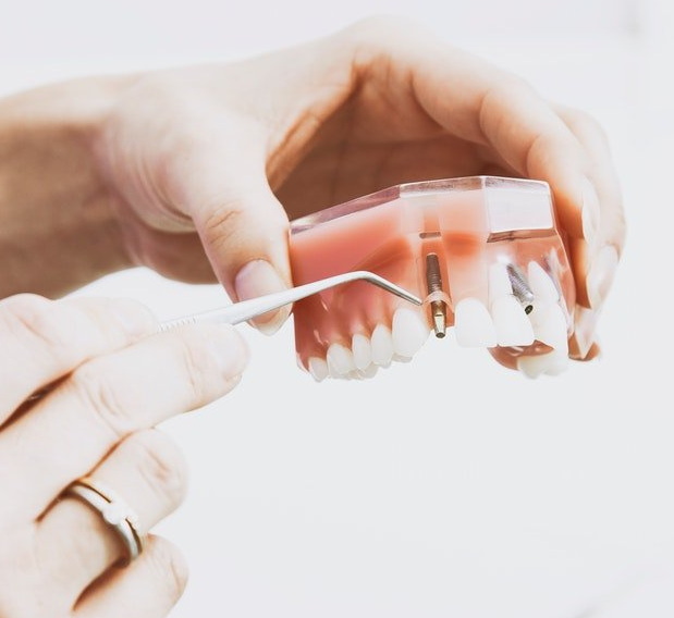 What To Expect Dental Implant?