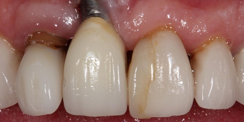 what is torque test dental implant_1
