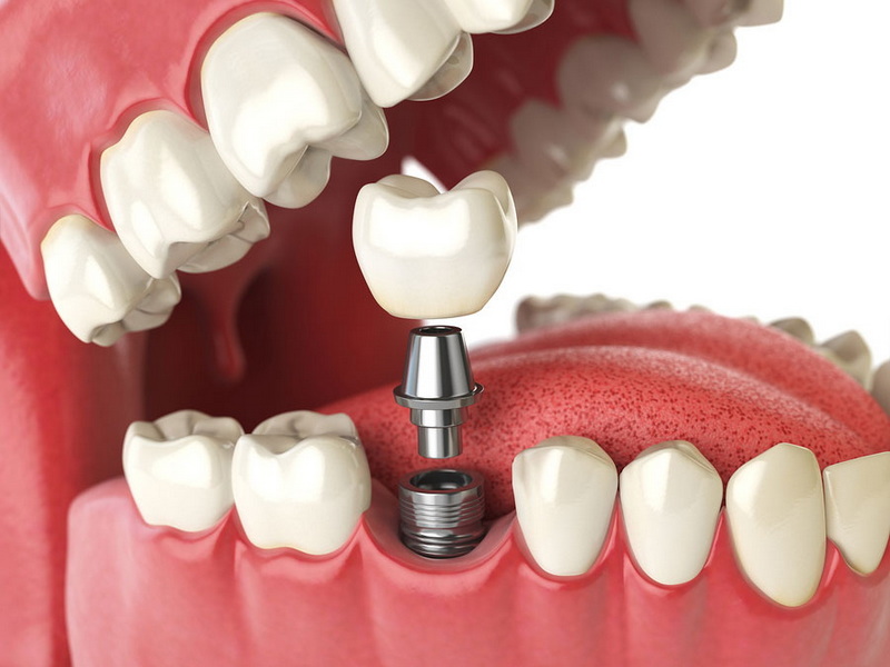 how long does it take to get a dental implant_05