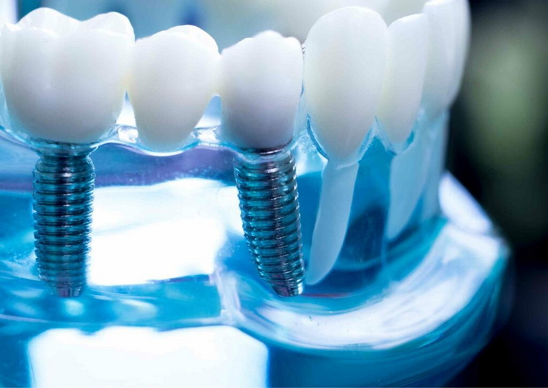 how is a dental implant done_03