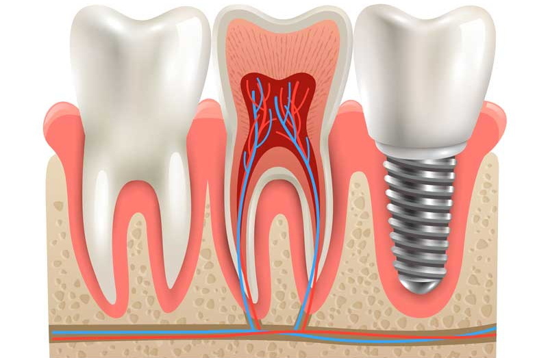  i don't get a dental implant_1