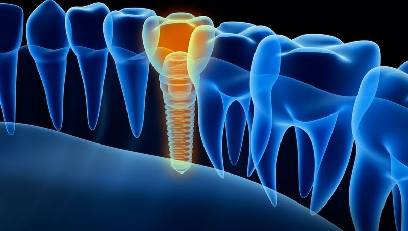 cause a dental implant to fail_3