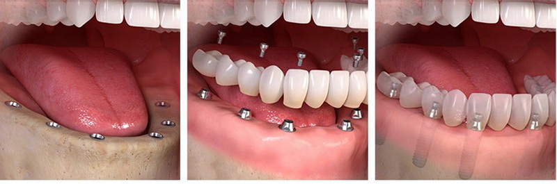 a dental implant_2