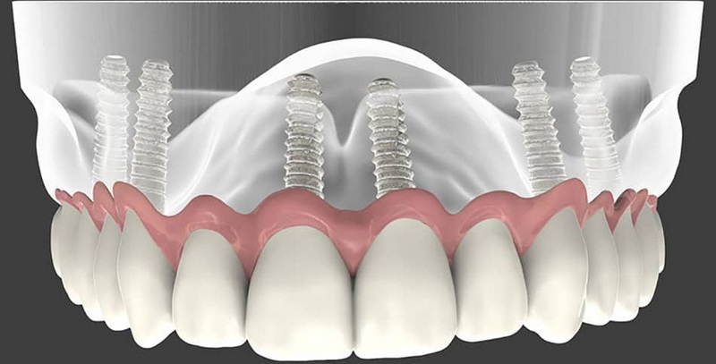 what a failed dental implant feel like_2