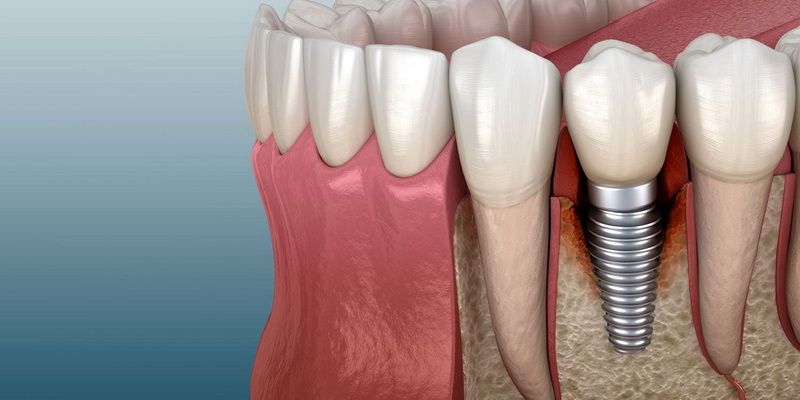 the symptoms of a dental implant rejection_2
