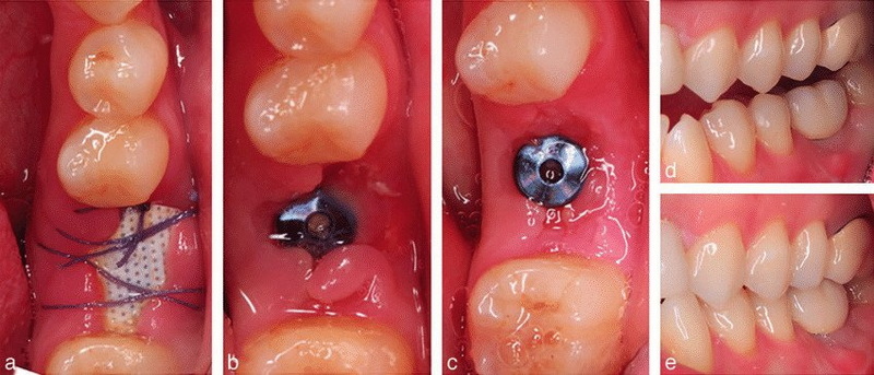 my dental implant be exposed_1