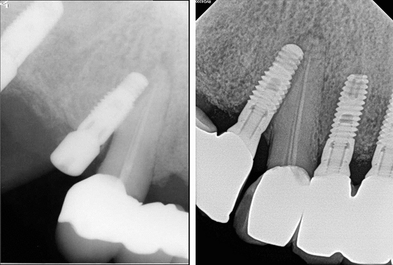 should i get a dental implant or not_2