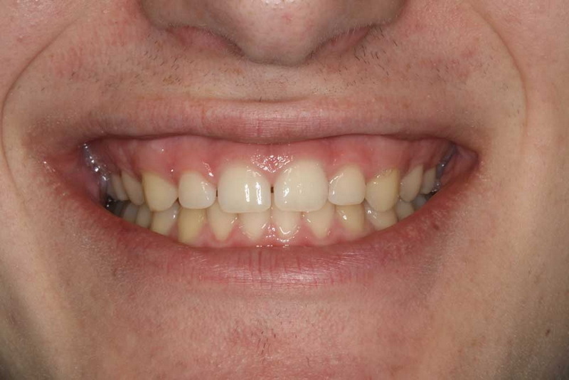 How Long Should I Wait To Smoke After Dental Implant?
