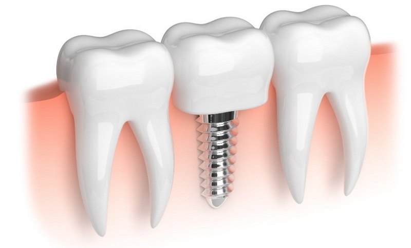 how long to have a healing abutment_1