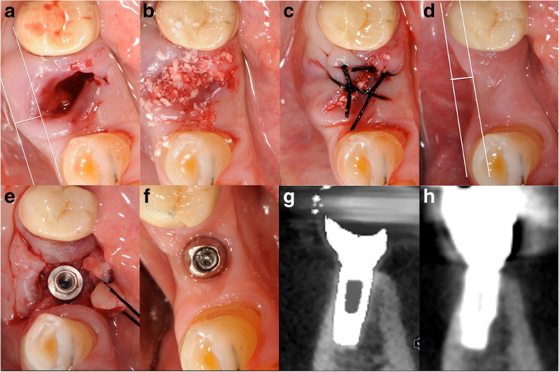 can you take edibles after dental implant