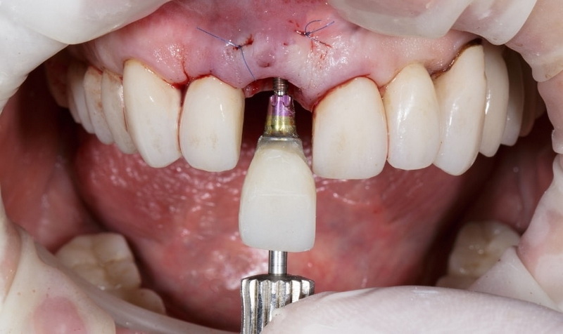 Can Gum Receding Be Reversed under Dental Implant?