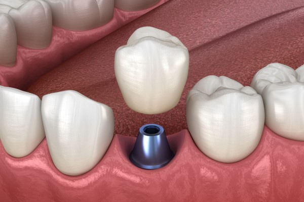 Can A Dental Abutment Be Put Back in After Falling Out?