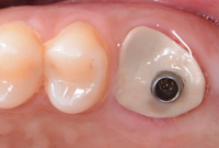 //iirorwxhloqjli5p.ldycdn.com/cloud/lnBpkKloljSRrlklnnpojq/company-dental-abutment-anti-rotational-connection.jpg
