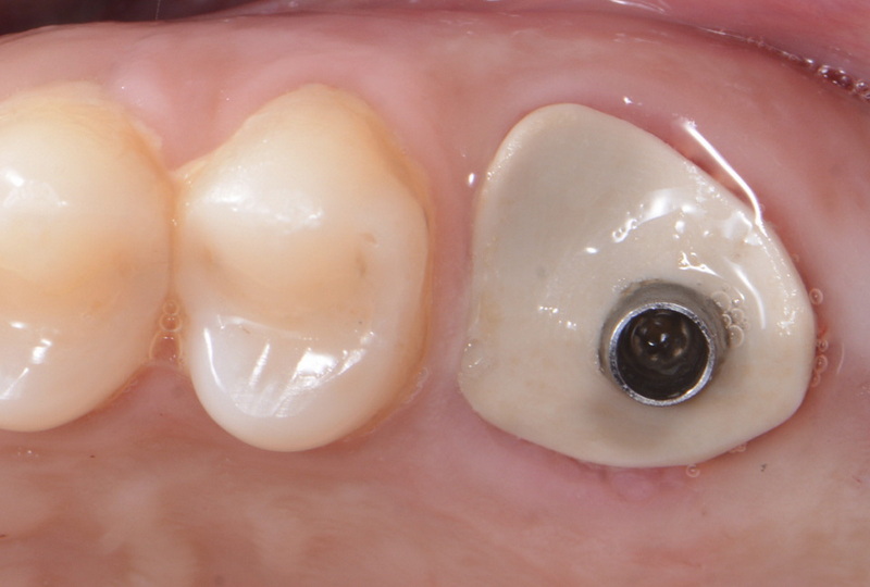 company dental abutment anti-rotational connection
