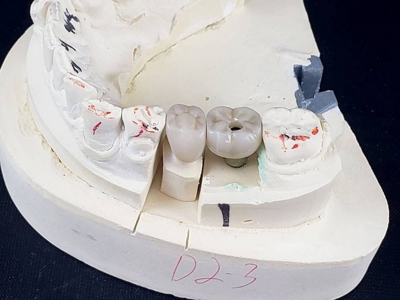 ankylos implant abutment screw can not be removed