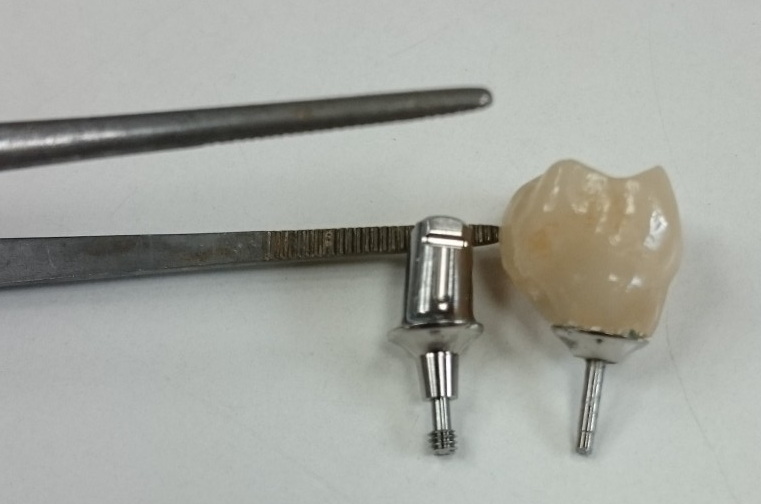 How Long Does It Take To Heal After An Abutment Is Placed?
