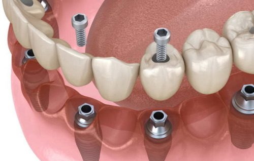 can you always remove a dental implant