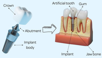//iirorwxhloqjli5p.ldycdn.com/cloud/lnBpkKloljSRrlmkiimpjq/best-dentist-to-put-dental-abutment-in.jpg