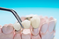 //iirorwxhloqjli5p.ldycdn.com/cloud/lnBpkKloljSRrlmljlqnjq/custom-healing-abutment-mold.jpg