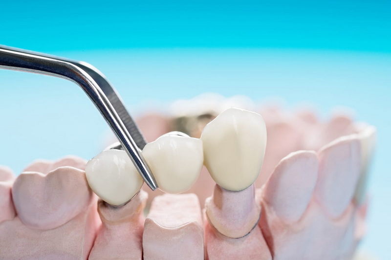 custom healing abutment mold