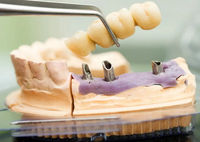 //iirorwxhloqjli5p.ldycdn.com/cloud/lnBpkKloljSRrlmlklpkjq/custom-healing-abutment-template.jpg