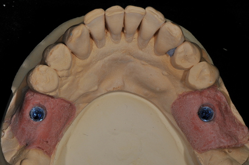 healing abutment infection