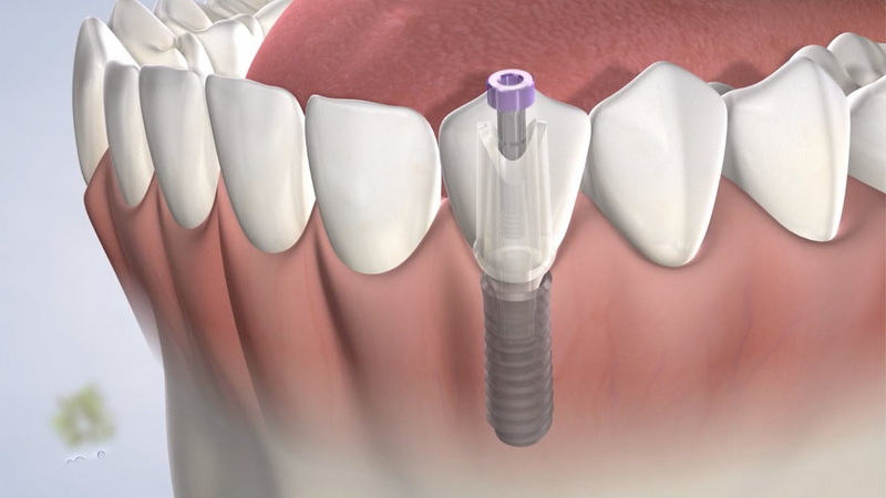 can i eat strawberries after a dental implant