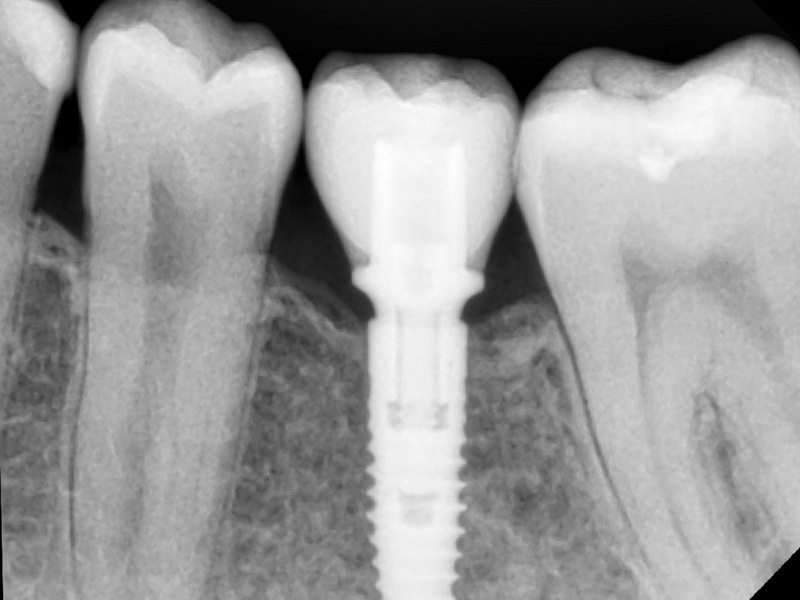 Does A Healing Abutment Hurt After Placement?