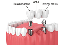 //iirorwxhloqjli5p.ldycdn.com/cloud/lnBpkKloljSRrlonqmkijq/healing-abutment-care.jpg
