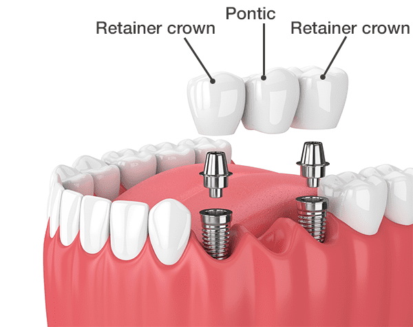 healing abutment care