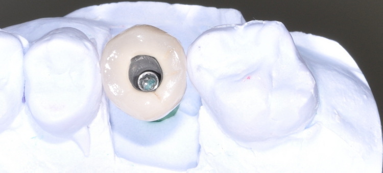 Can I Get Invisalign If I Have A Dental Implant?