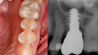 //iirorwxhloqjli5p.ldycdn.com/cloud/lnBpkKloljSRrlqlimqkjq/abutment-screw-loosening-adhesive.jpg