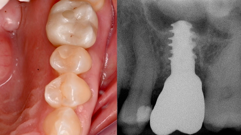 How To Properly Apply Adhesive for Abutment Screw Stability?