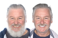 //iirorwxhloqjli5p.ldycdn.com/cloud/lnBpkKloljSRrlqlllmkjq/can-you-glue-a-dental-implant-back-in.jpg