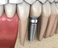//iirorwxhloqjli5p.ldycdn.com/cloud/lnBpkKloljSRrlqlnlirjo/can-you-have-a-dental-implant-through-amalgam-tattoo-tissue.jpg