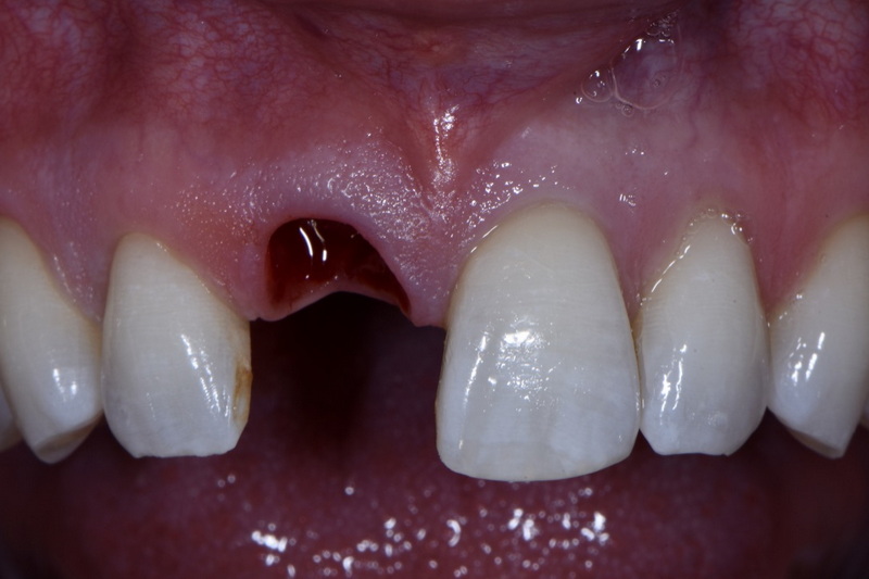 Can A Dental Implant Cause Tinnitus?