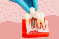 //iirorwxhloqjli5p.ldycdn.com/cloud/lnBpkKloljSRrlrlpopnjq/can-you-get-dental-implant-if-you-extract.jpg