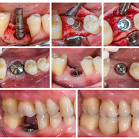 //iirorwxhloqjli5p.ldycdn.com/cloud/lnBpkKloljSRrlrlrllmjo/3i-encode-healing-abutment.jpg