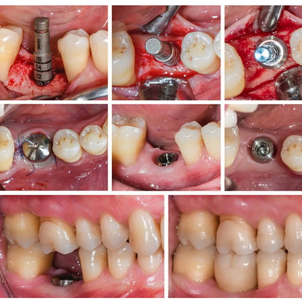 3i encode healing abutment