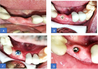 //iirorwxhloqjli5p.ldycdn.com/cloud/lnBpkKloljSRrlrnjrmnjo/can-you-over-tighten-a-dental-implant.jpg