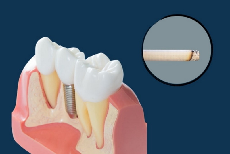 can you smoke weed after a dental implant